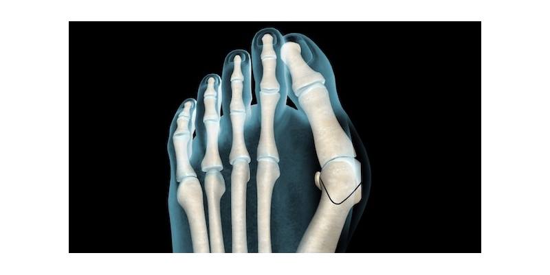 Hallux Valgus